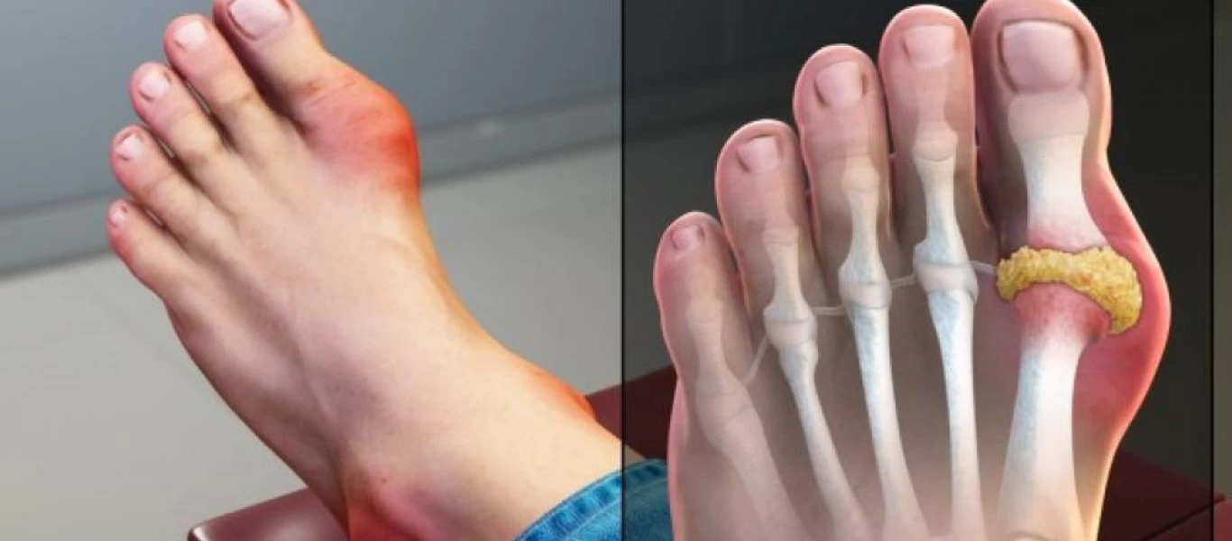 Ουρικό οξύ: Ποιες τροφές το ανεβάζουν – Τα κύρια συμπτώματα του